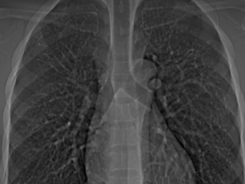 chest-x-ray